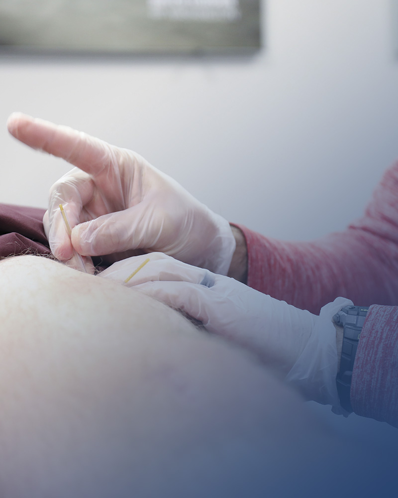 Dry needling being done on athletic patient