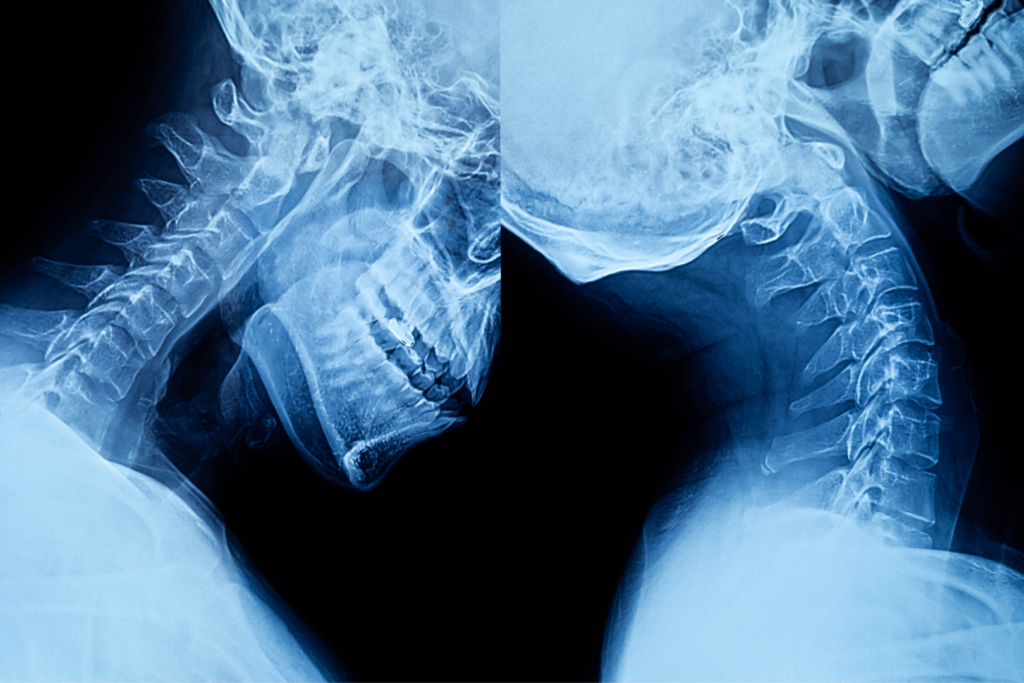 X ray of Belayer's Neck