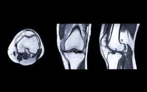 Read more about the article ACL Injuries & Prevention in Sports