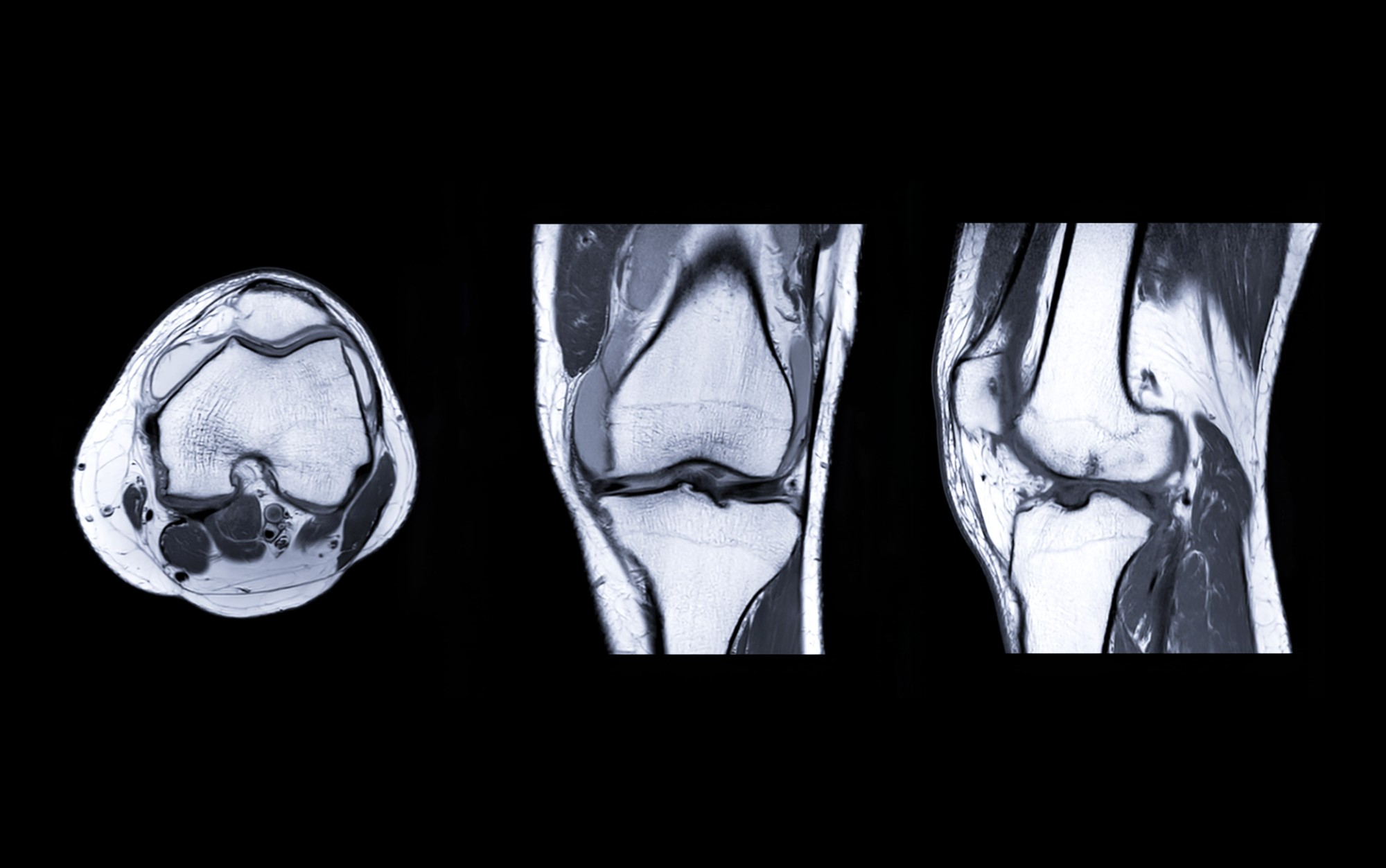 ACL Injuries & Prevention in Sports - FX Physical Therapy