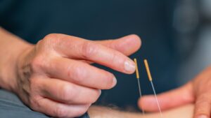 Read more about the article The Benefits of Dry Needling